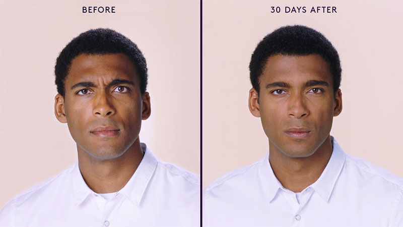 Botox Before and After of Male's Face