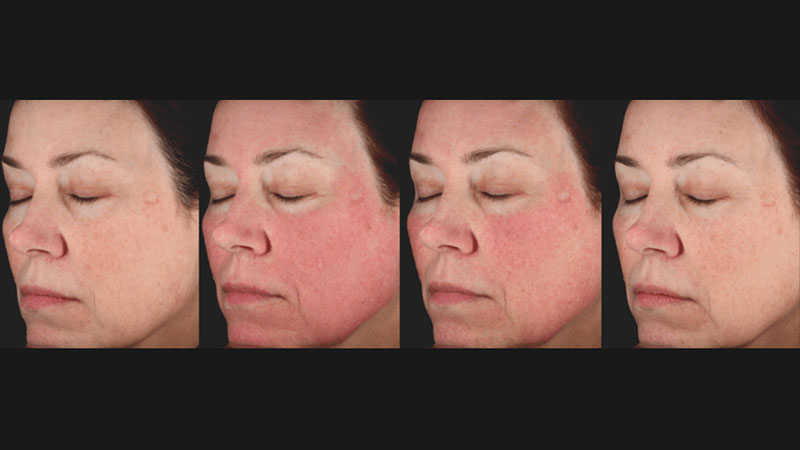 Before & After Picosure Face