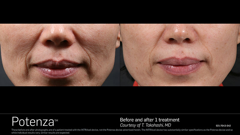 Before & After Potenza nose and mouth