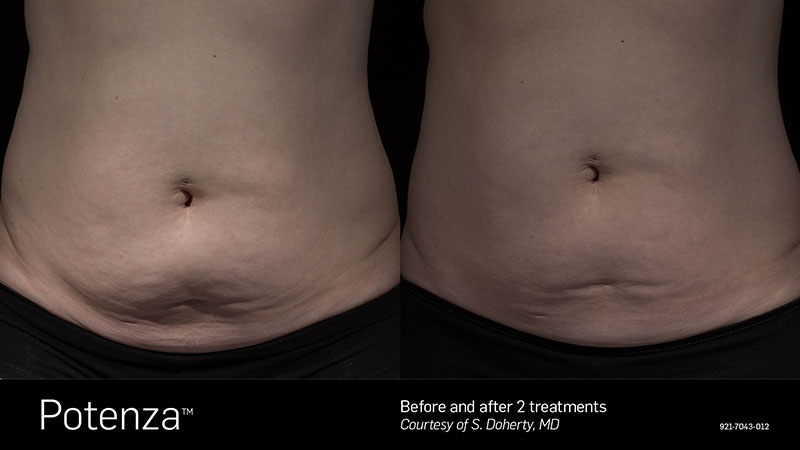 Before & After Potenza Stomach