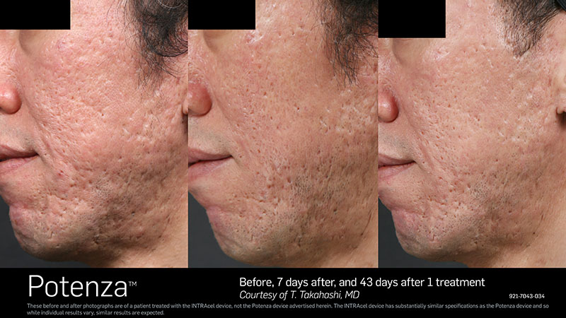 Before & After Potenza Side profile of Face
