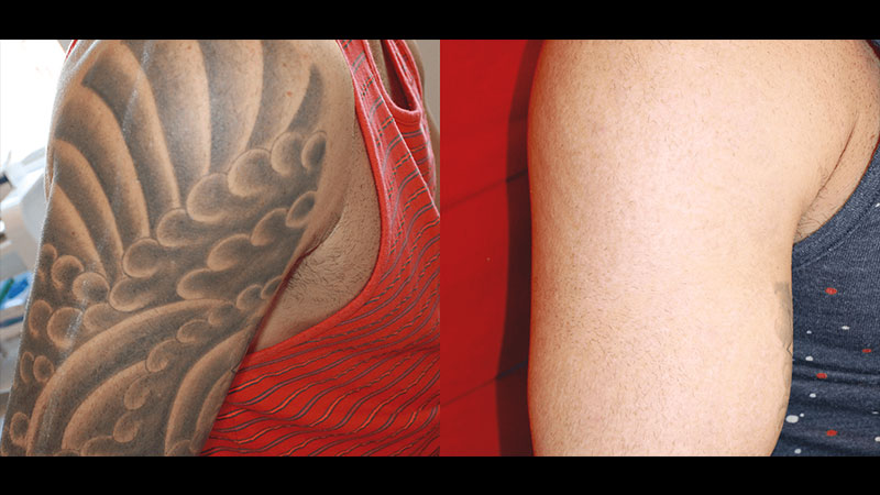 Tattoo Removal Before & After Arm