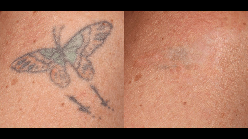 Tattoo Removal Before & After close up of arm tattoo of butterfly