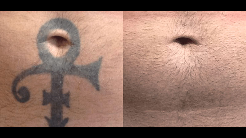 Tattoo Removal Before & After close up of belly tattoo